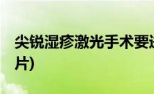 尖锐湿疹激光手术要进手术室吗(尖锐湿疣 图片)