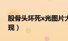 股骨头坏死x光图片大全（股骨头坏死x线表现）