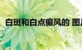 白斑和白点癫风的 图片区别（婴儿白癜风）