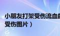 小朋友打架受伤流血的图片卡通（小朋友打架受伤图片）